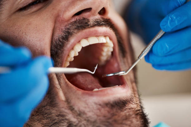 Best Emergency Dental Care for Broken or Chipped Teeth in Granite Hills, CA