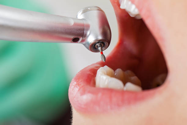 Best Emergency Wisdom Teeth Removal in Granite Hills, CA